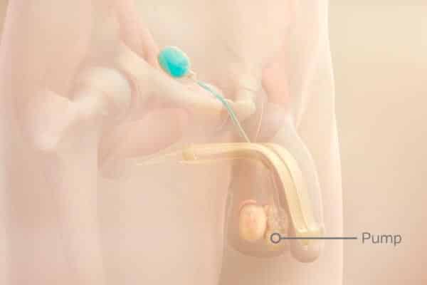Aufpumpbare-Penisprothese-Kasten